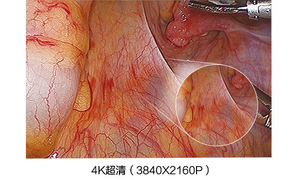 為什么選擇4K超高清內(nèi)窺鏡攝像系統(tǒng)